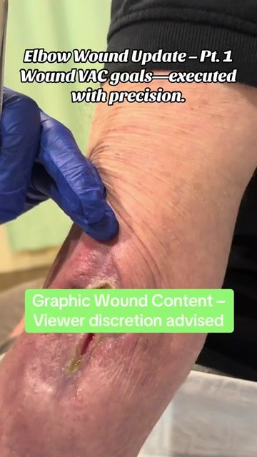 thumbnail Elbow Wound Update After Wound Vac
