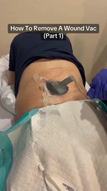 thumbnail How To Remove A Wound Vac Part 1