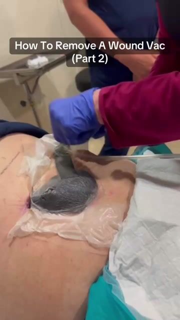 thumbnail How To Remove a Wound Vac Part 2