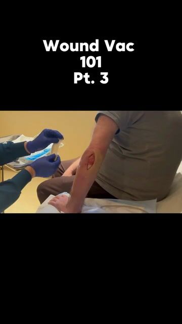 thumbnail Why We Protect Healthy Tissue During Wound VAC