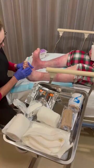 thumbnail How to Apply an Unna Boot