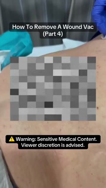 thumbnail How to Remove a Wound Vac Part 4