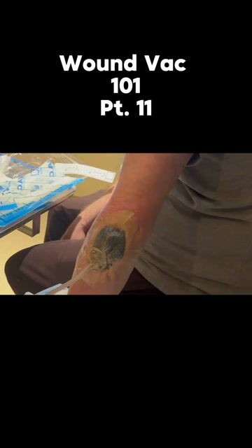 thumbnail Sealing the Deal: Fixing a Wound VAC Leak