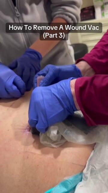 thumbnail How To Remove Wound Vac Part 3