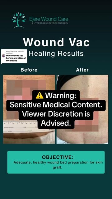 thumbnail Wound VAC Healing Results